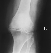 Osteoarthritis Knee Xray