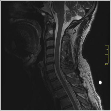 Primary intraosseous haemangioma | Radiology Reference Article ...