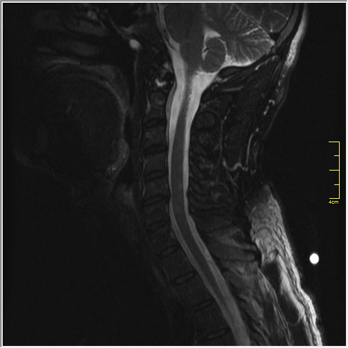 Vertebral hemangioma involving dens | Image | Radiopaedia.org