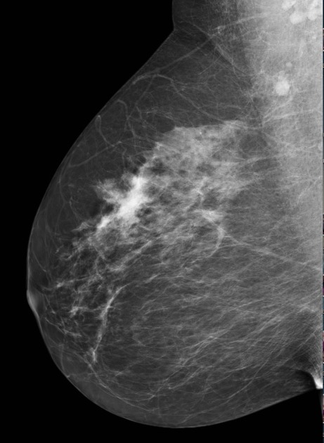 Axillary lymph nodes mammogram Radiology Case Radiopaedia