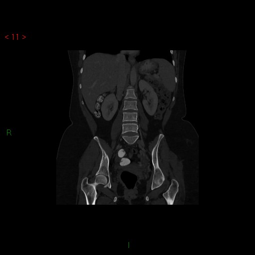 Osteitis Condensans Ilii And Pubis Image