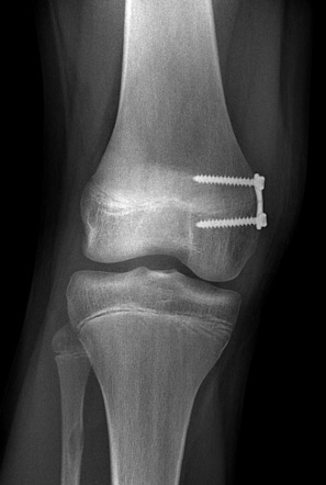 Temporary hemiepiphysiodesis (knee) | Radiology Case | Radiopaedia.org