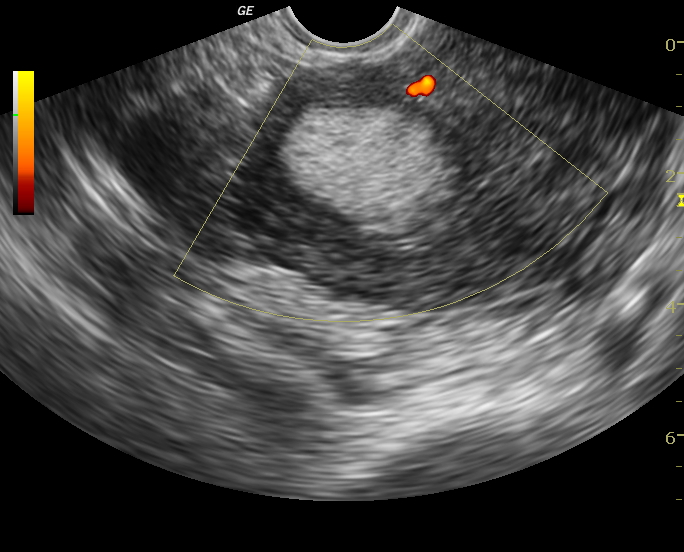 Lipoleimyoma masquerading as uterine prolapse