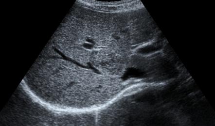 Coarsened Hepatic Echotexture Radiology Reference Article Radiopaedia Org