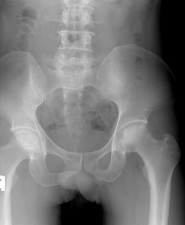 Crescent sign (osteonecrosis) | Radiology Reference Article ...