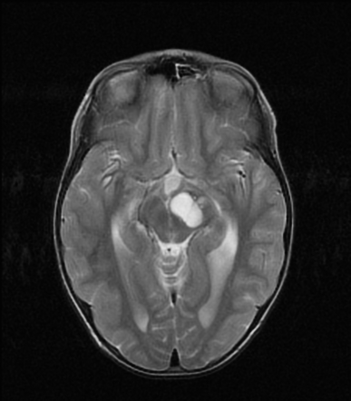 Perivascular spaces | Radiology Reference Article | Radiopaedia.org