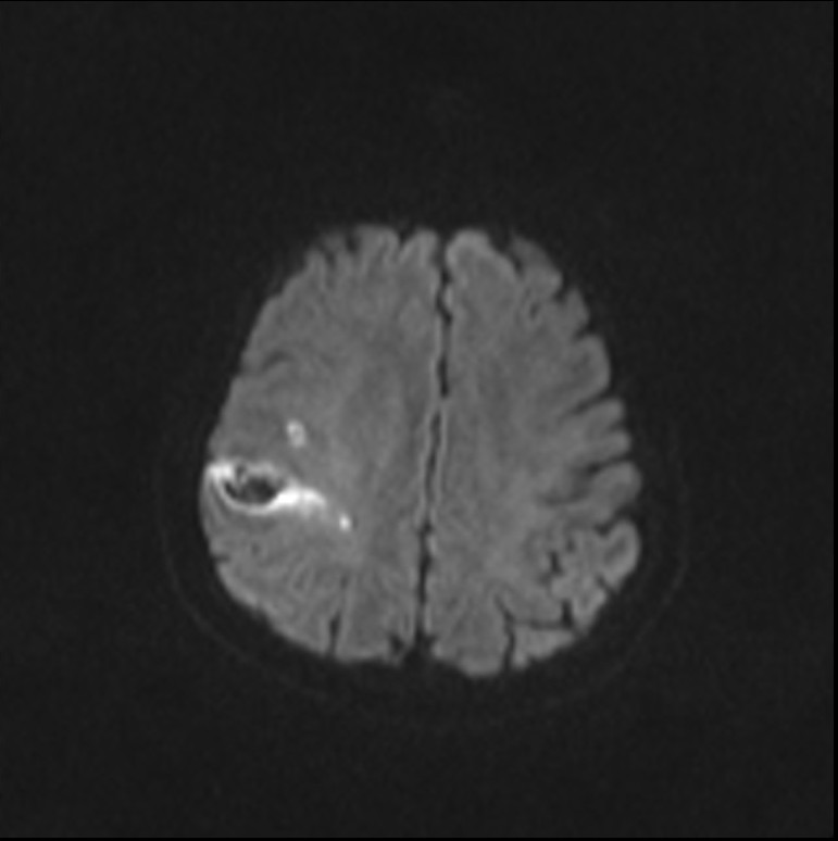 Cerebral Amyloid Angiopathy Related Lobar Hemorrhage | Image ...