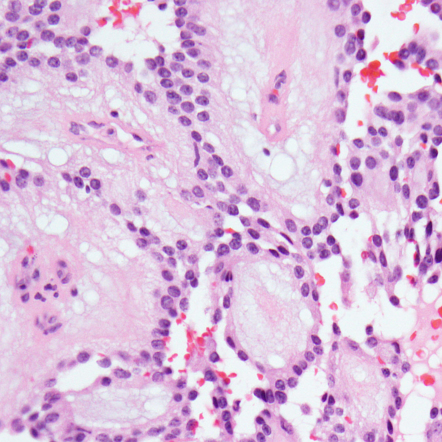 Myxopapillary ependymoma (histology) | Image | Radiopaedia.org