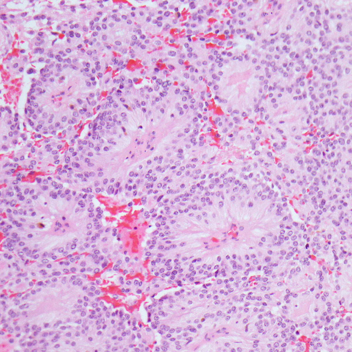 Myxopapillary ependymoma (histology) | Image | Radiopaedia.org