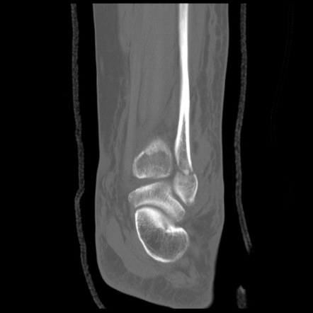 Ankle Fracture: Weber B3 | Radiology Case | Radiopaedia.org