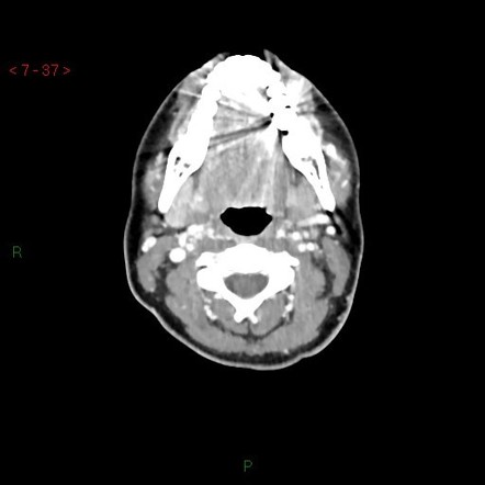 Primary breast lymphoma | Radiology Case | Radiopaedia.org