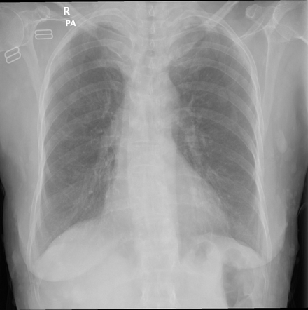 Cutaneous neurofibromatosis (chest X ray) | Radiology Case ...