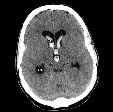 Intraventricular Hemorrhage Due To Pial Arteriovenous Malformation ...