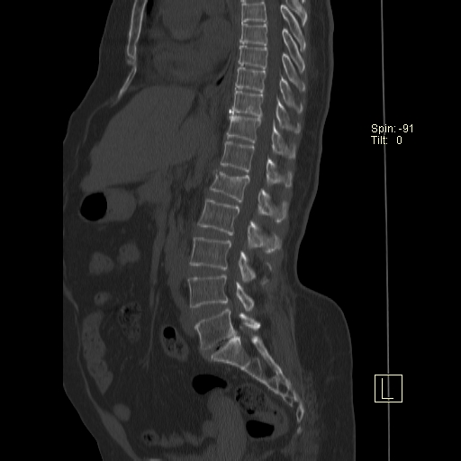 Wedge Compression Fracture L1 Image