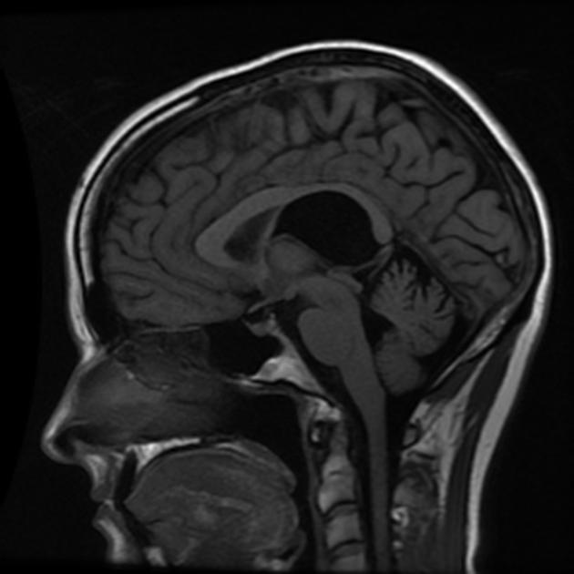 cavum velum interpositum ultrasound