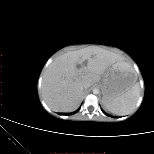 Biliary tract embryonal rhabdomyosarcoma | Image | Radiopaedia.org