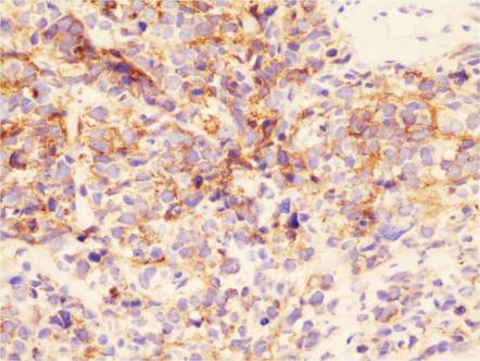 Biliary tract embryonal rhabdomyosarcoma | Image | Radiopaedia.org