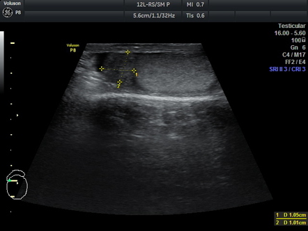 Indirect inguinal hernia | Image | Radiopaedia.org