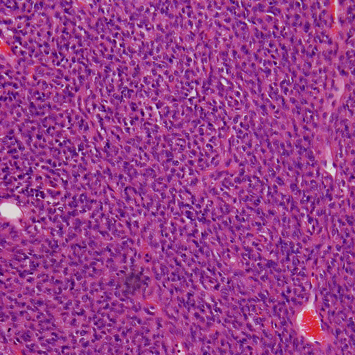 Solitary Fibrous Tumor Histology