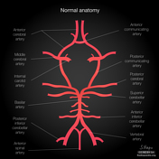 Posterior inferior cerebellar artery, Radiology Reference Article