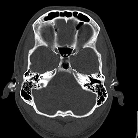 Cauliflower ear | Radiology Reference Article | Radiopaedia.org