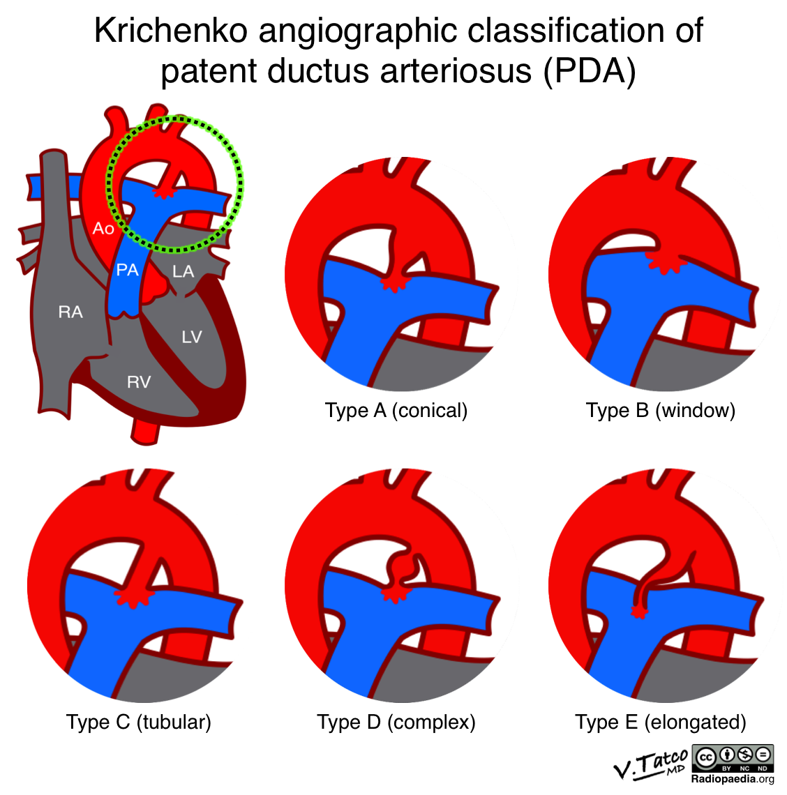 Krichenko angiographic classification of patent ductus arteriosus