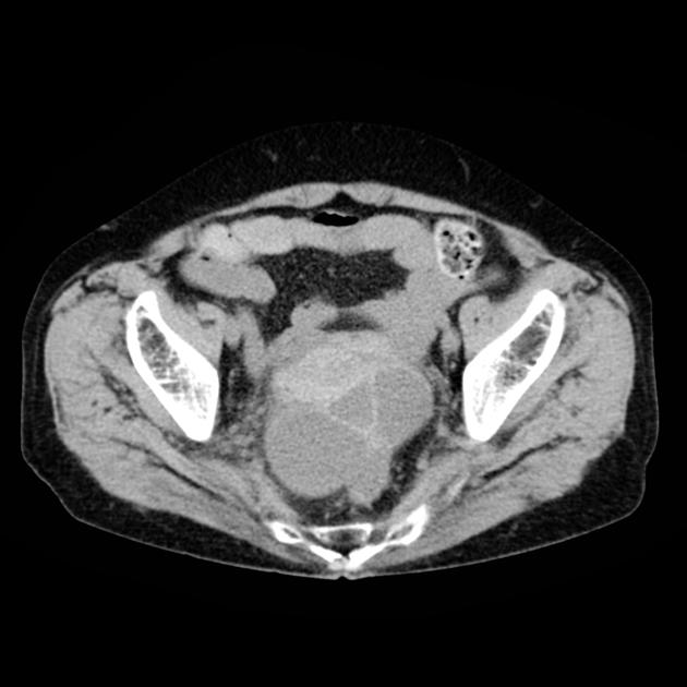 Endometriosis Radiology Case Radiopaedia Org