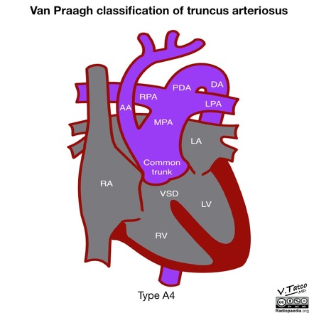 Van Praagh classification of truncus arteriosus (illustration) | Image ...