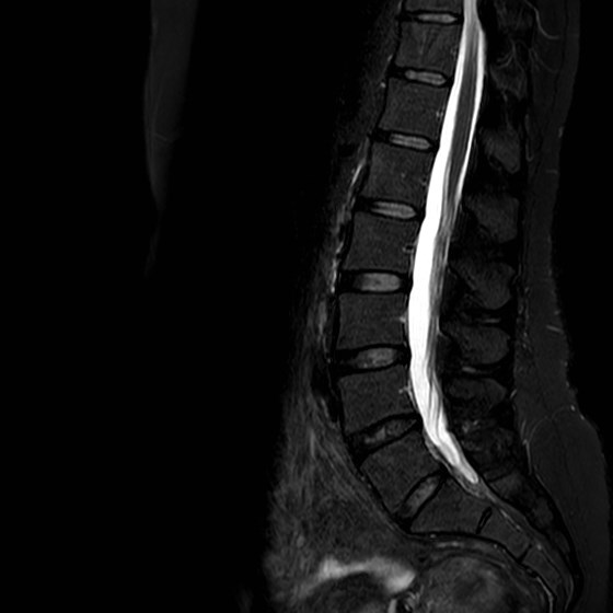 Conjoined nerve root L5-S1 with hemilumbarisation S1 | Image ...