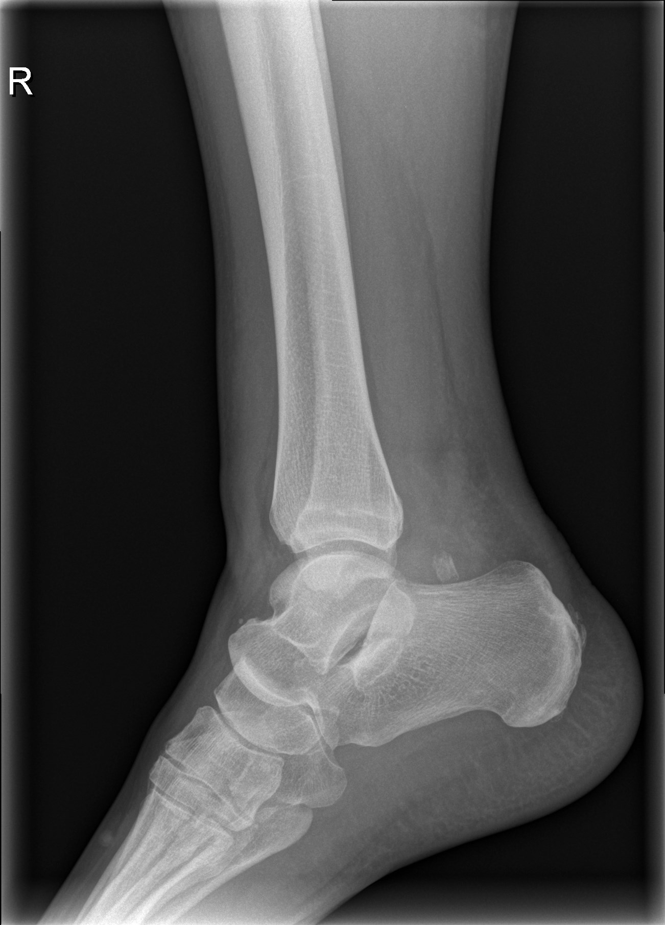 Lateral peritalar dislocation | Image | Radiopaedia.org