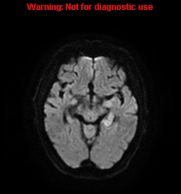 Limbic encephalitis - small cell lung cancer | Image | Radiopaedia.org