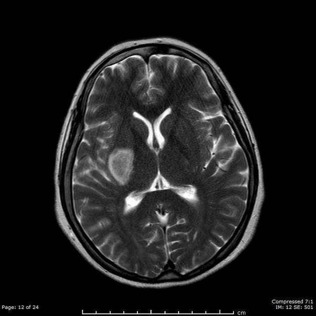 Prothrombin 20210 Mutation | Radiology Reference Article | Radiopaedia.org