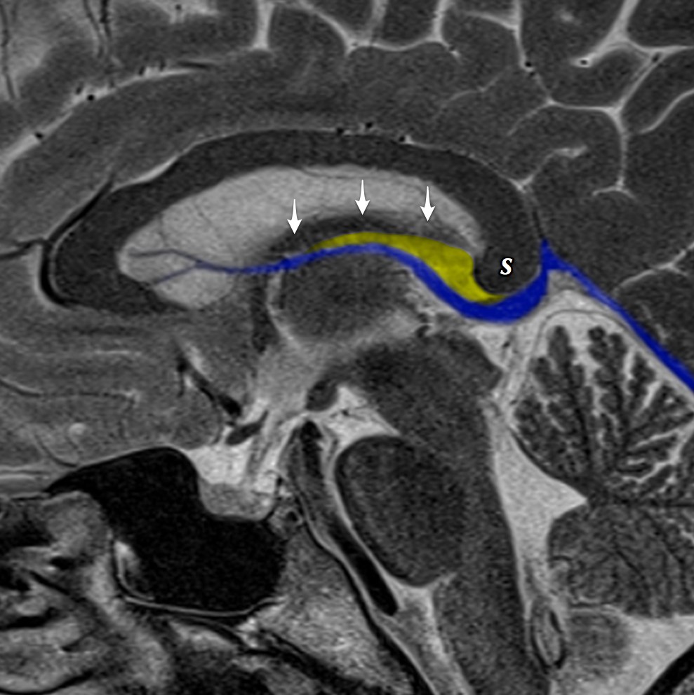 Cavum velum interpositum cyst Image