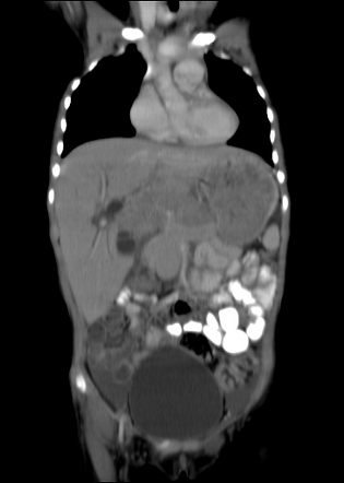 Biliary tract embryonal rhabdomyosarcoma | Image | Radiopaedia.org