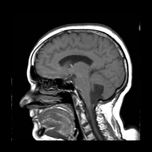 Epidermoid Cyst 4th Ventricle Image 5263