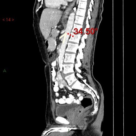 Nutcracker phenomenon | Radiology Case | Radiopaedia.org