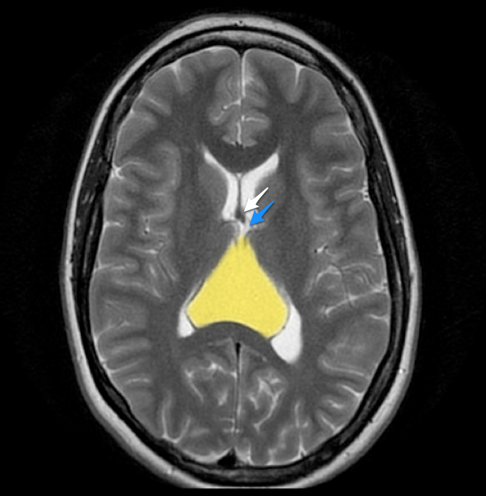 Cavum velum interpositum cyst | Image | Radiopaedia.org