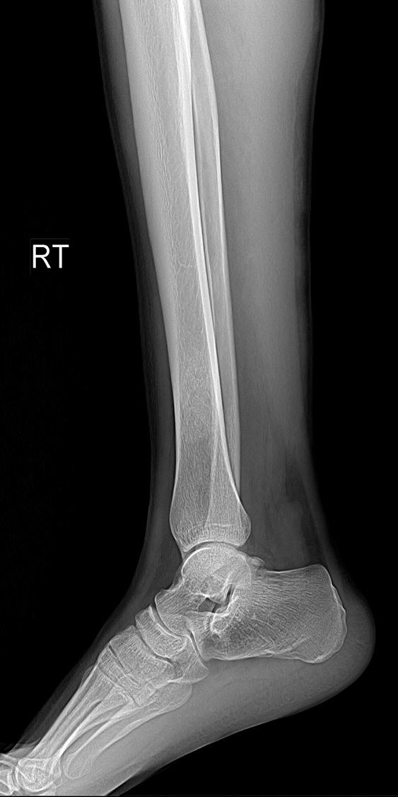 Healing non-ossifying fibroma | Image | Radiopaedia.org