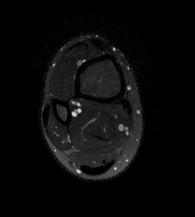 Healing non-ossifying fibroma | Image | Radiopaedia.org