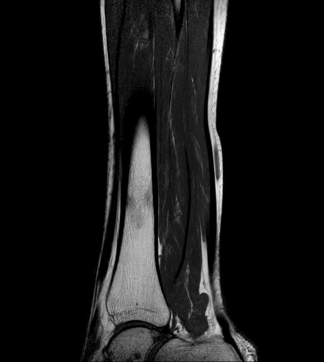 Ossifying Fibroma Femur