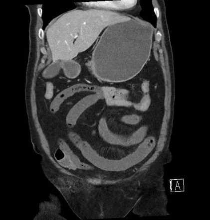 Intestinal ischemia - Pictures