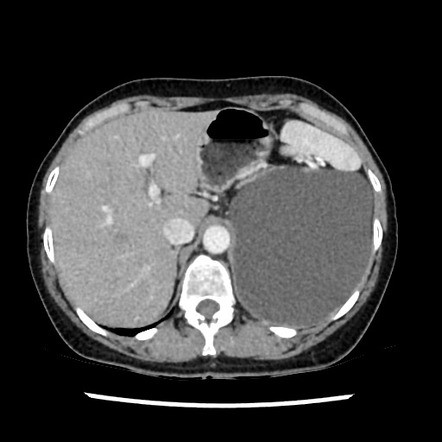 Cystic adrenal neoplasm | Radiology Reference Article | Radiopaedia.org