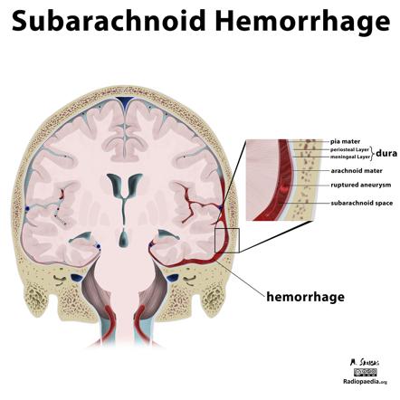 CT brain image gallery - SAH