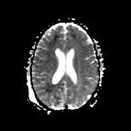 Extensive Dural Venous Sinus Thrombosis Image Radiopaedia Org