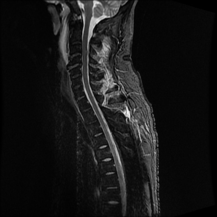 Ligament injury and cord edema in cervical spine trauma | Radiology ...