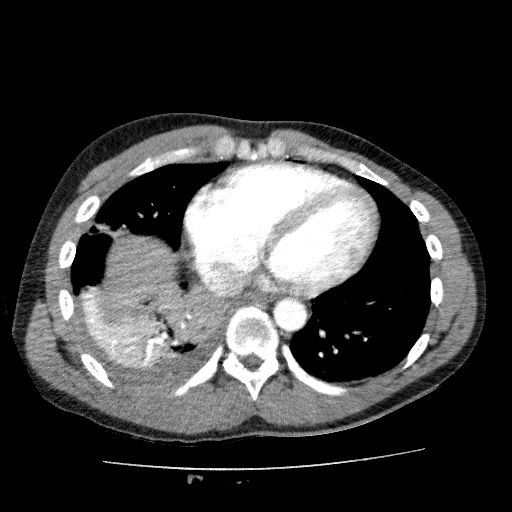 File:Traumatic rib fractures, pneumothorax and liver laceration ...