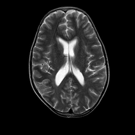 Right middle cerebral artery infarction | Image | Radiopaedia.org