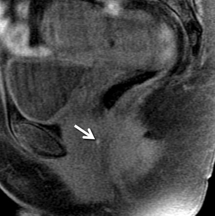 Endometriosis | Radiology Reference Article | Radiopaedia.org