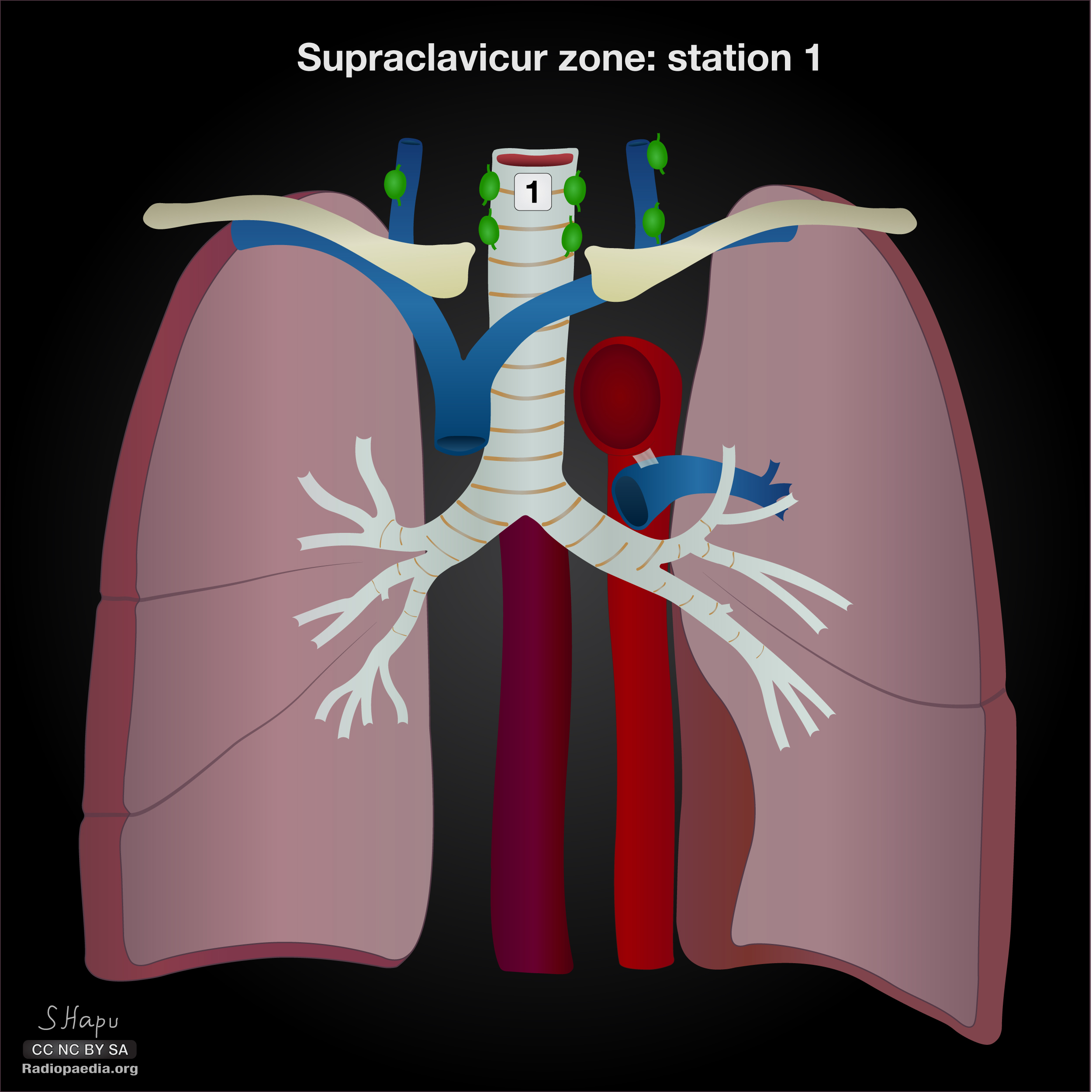 Thoracic lymph node stations (illustrations) | Image | Radiopaedia.org