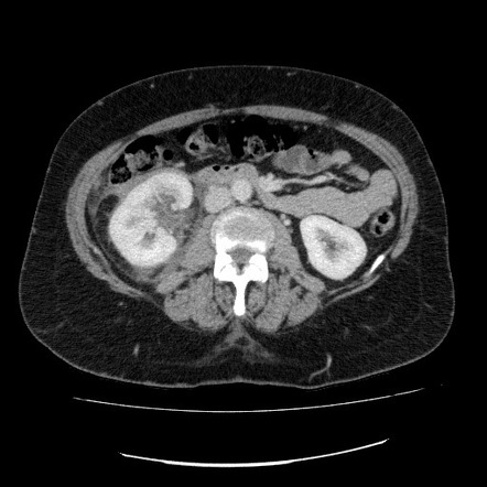 Renal trauma - AAST grade IV injury | Image | Radiopaedia.org